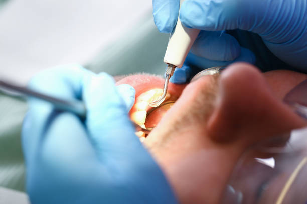 Best Emergency Wisdom Tooth Extraction in Huntland, TN